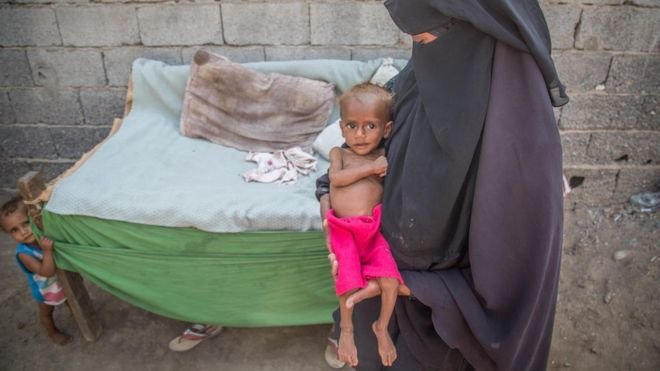 ۸۵۰۰۰ کودک در یمن به علت سوءتغذیه درگذشته‌اند