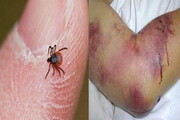 فوت دومین بیمار مبتلا به تب کریمه کنگو در ایران | افزایش آمار جانباختگان به ۱۸ نفر