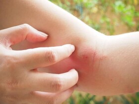 نکته بهداشتی: تسکین خارش پوست
