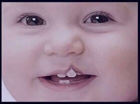 دلایل ابتلاء به یکی از شایع‌ترین بیماری‌های مادرزادی سر و صورت