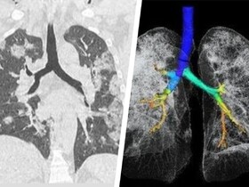 درباره بیماری ریوی ناشی از ویروس کرونا| آیا بعد از بهبودی ریه‌ها دچار آسیب دائمی می‌شوند؟