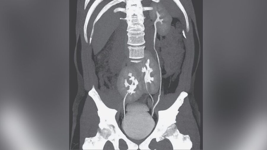 kidney scan