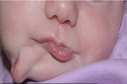 تصاویر | تولد نوزادی با دو دهان | دهان اضافه برداشته شد