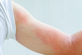 اگر علائم پوستی همراه با تب باشد، باید احتمال کرونا را در نظر داشت