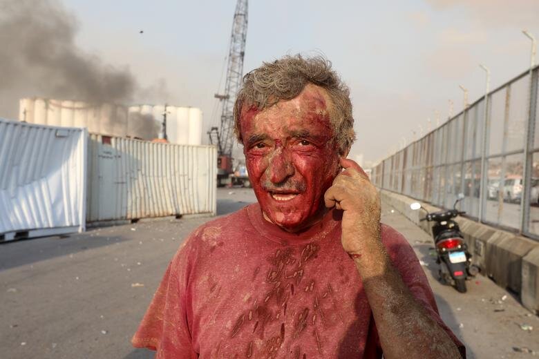 مرد زخمی پس از انفجار بزرگ بیروت