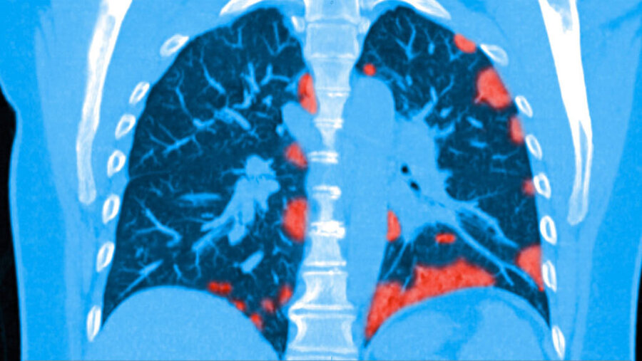 LUNG SCAN