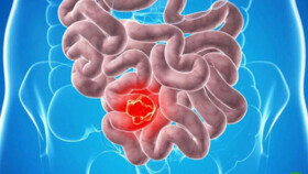 دو علامت کلیدی که ممکن است بیانگر ابتلا به سرطان روده بزرگ باشند
