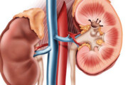 کشف درمان جدید نارسایی کلیه