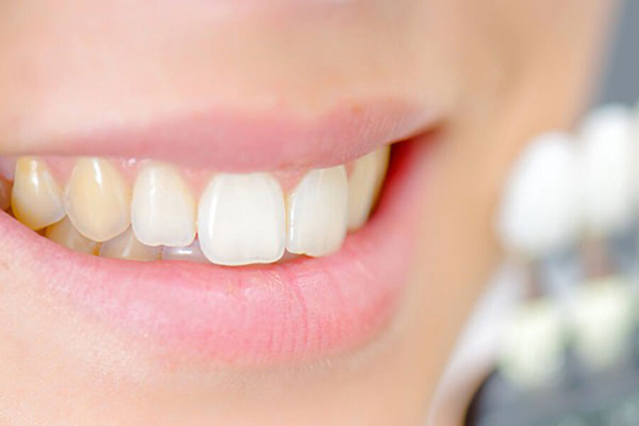 prevent yellowing of teeth - زرد شدن رنگ دندان