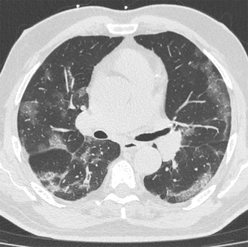 LUNG CT