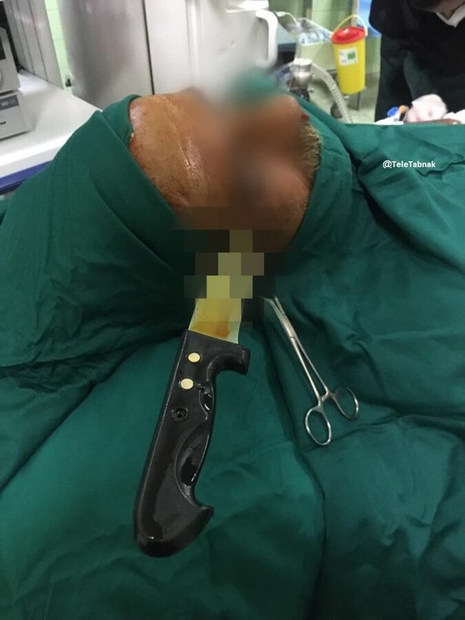 تصاویر | خارج کردن چاقوی آشپزخانه از جمجمه یک مرد در بیمارستان لقمان