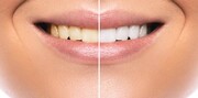 تاثیر مخرب محصولات سفید کننده بر دندان‌ها