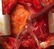 موفقیت جراحان ایرانی در اهدای اعضای بیمار مرگ مغزی غیر کنترل شده