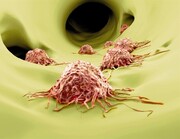 پیشگیری از متاستاز تومور با به خواب بردن سلول‌های سرطانی!