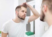 پیوند موی طبیعی با چه روش‌هایی انجام می‌شود؟