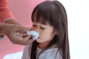 چطور خونریزی از بینی در کودکان را بند بیاوریم؟