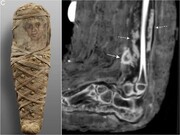 رازهایی که یک کودک مومیایی‌شده از پزشکی باستانی آشکار می‌کند