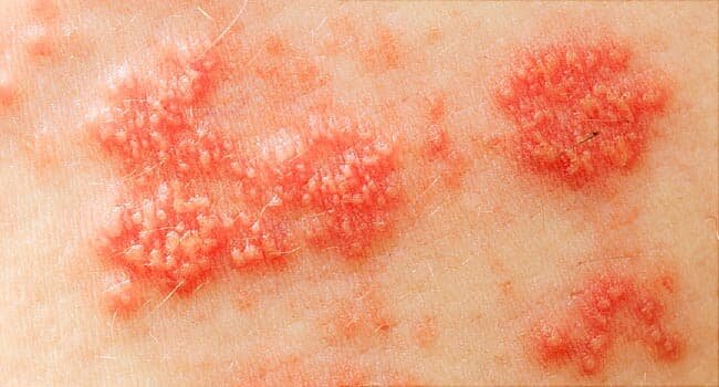 علت ایجاد بیماری پوستی «زونا» چیست؟ Shingles