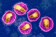 سومین مورد علاج از ویروس ایدز| درمان زن مبتلا به اچ‌آی‌وی با  پیوند سلول بنیادی از خون بند ناف