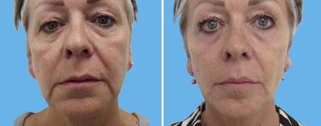 نکات مهمی که باید قبل از لیفت صورت با نخ بدانید