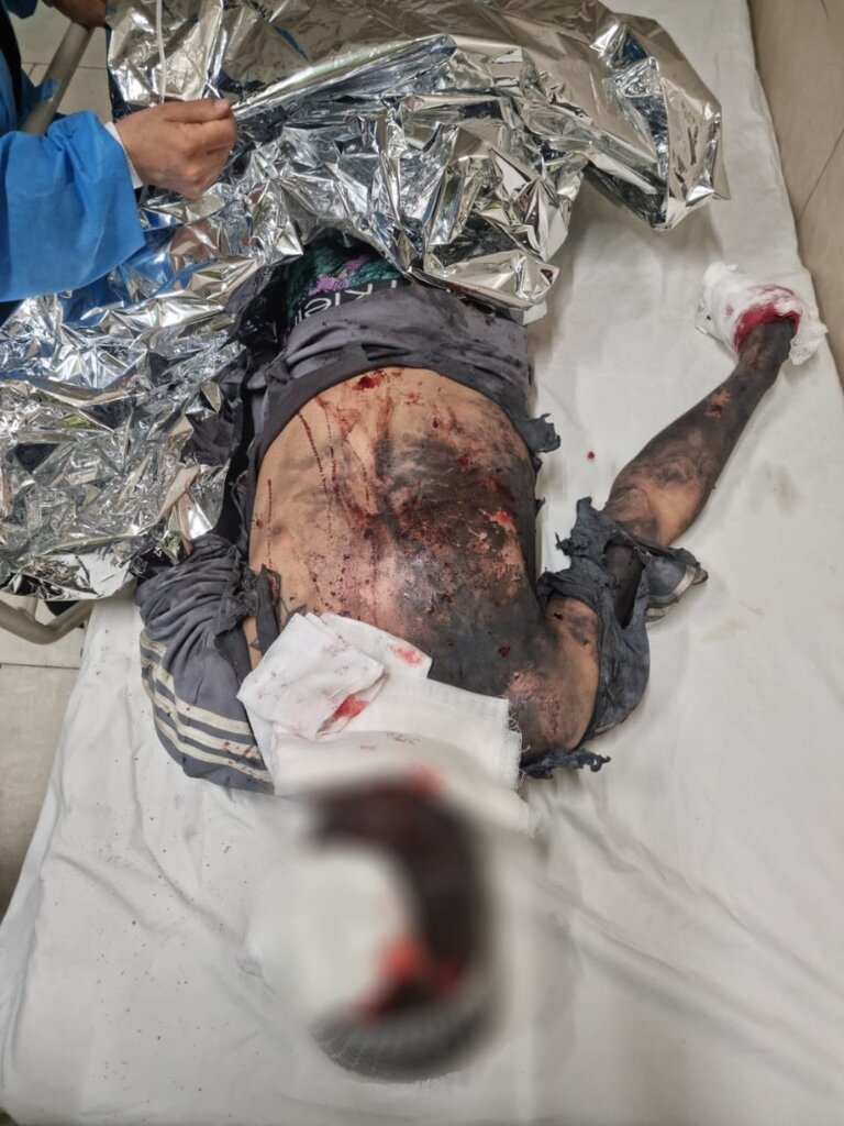 تصاویر دلخراش از مصدومیت ۳ نفر بر اثر انفجار مواد محترقه