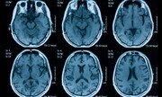 کرونا می‌تواند باعث تحلیل رفتن مغز و آسیب به بافت‌های آن شود