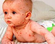 هشدار وزارت بهداشت درباره ورود سرخک به ایران | ثبت ۲ مورد مرگ بر اثر سرخک | کودکان باید واکسینه شوند؟