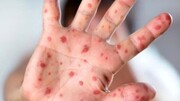افزایش نگرانی‌ها درباره شیوع یک ویروس کشنده در بین کودکان ایرانی | گزارش نخستین مورد ابتلا در قم | واکنش مهم یک مقام بهداشتی