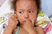 علائم سرخک در کودکان را بشناسید | بزرگسالان هم باید واکسن سرخک بزنند؟