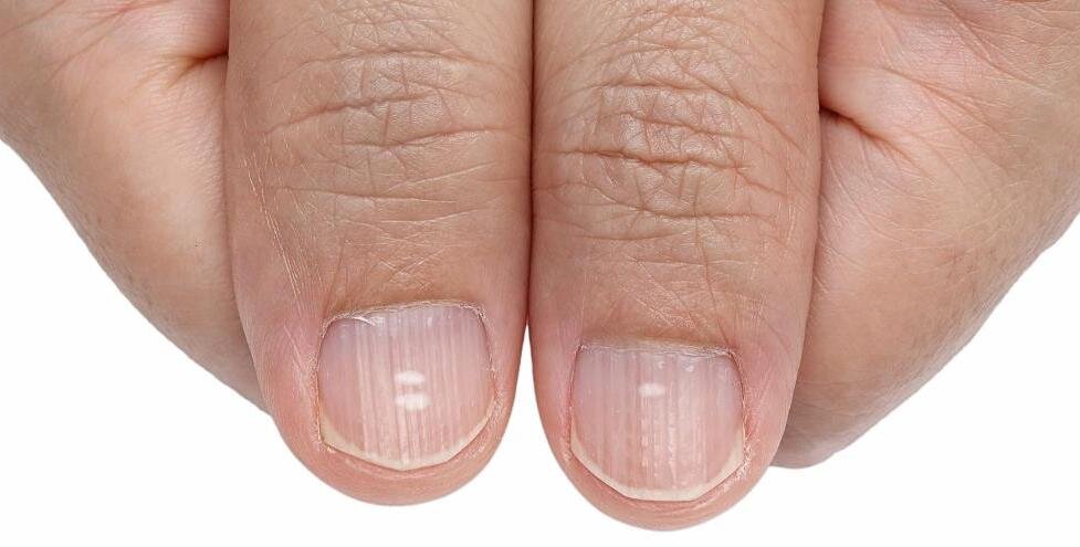 تغییر شکل ناخن نشانه چیست؟ | کمبود ریزمغذیها را از شکل ناخن متوجه شوید