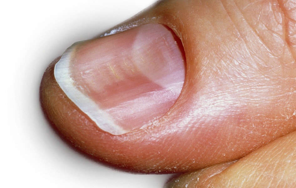 تغییر شکل ناخن نشانه چیست؟ | کمبود ریزمغذیها را از شکل ناخن متوجه شوید