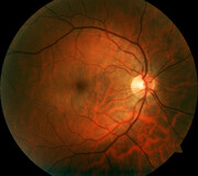 کرونا ممکن است خطر لخته‌های خونی نادر چشمی را افزایش دهد
