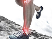 شین اسپلینت یا درد جلوی ساق پا