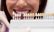 هر آنچه که باید درباره لمینت دندان و انواع آن بدانید!
