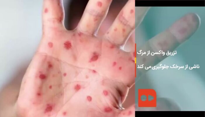 تزریق واکسن از مرگ ناشی از سرخک جلوگیری می‌کند