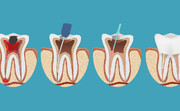 درباره عمل «روت کانال» یا درمان ریشه دندان