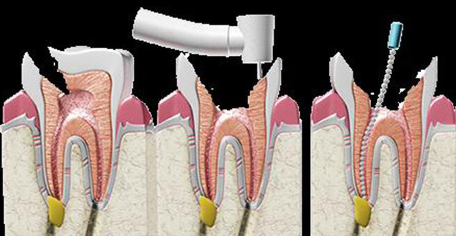 درباره عمل «روت کانال» یا درمان ریشه دندان