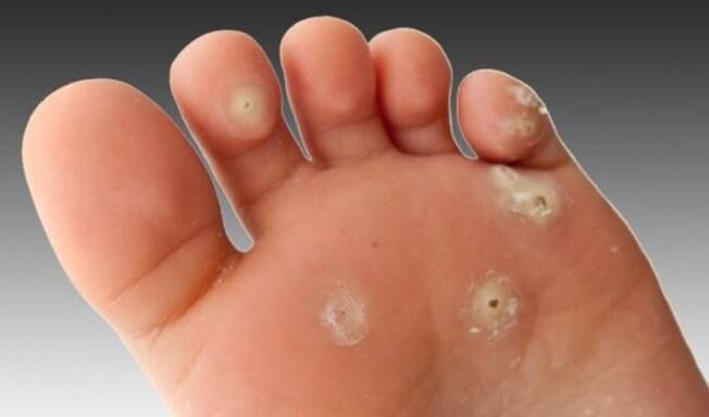 درمان میخچه پا در منزل