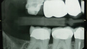 دندان‌ها پس از روت کانال چه مدت دوام می‌آورند؟
