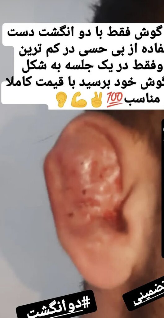 گوش شکسته