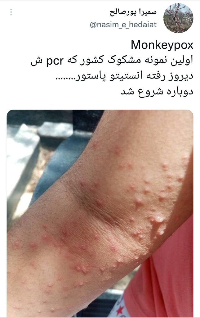 آبله میمونی به ایران رسید؟ | انتشار تصویر یک کودک ایرانی مشکوک به ابتلا به آبله میمونی