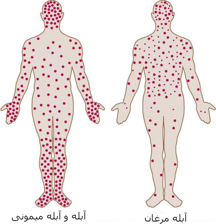 علائم آبله میمونی چه تفاوتی با آبله مرغان دارد؟