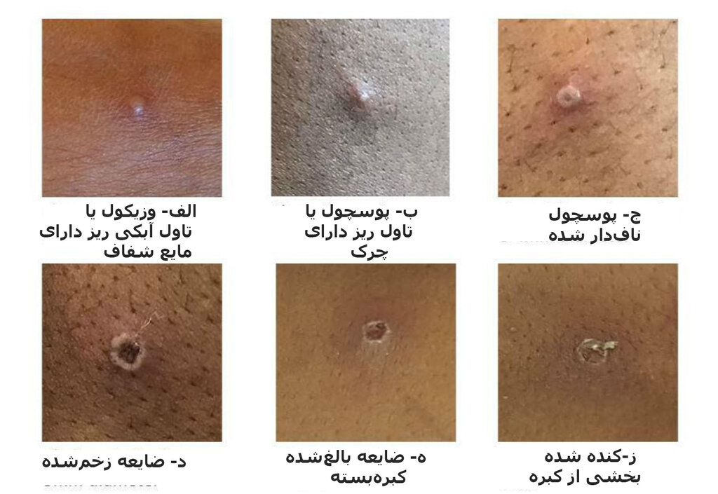 تفاوت آبله مرغان و آبله میمونی علائم آبله میمونی چه تفاوتی با آبله مرغان دارد؟