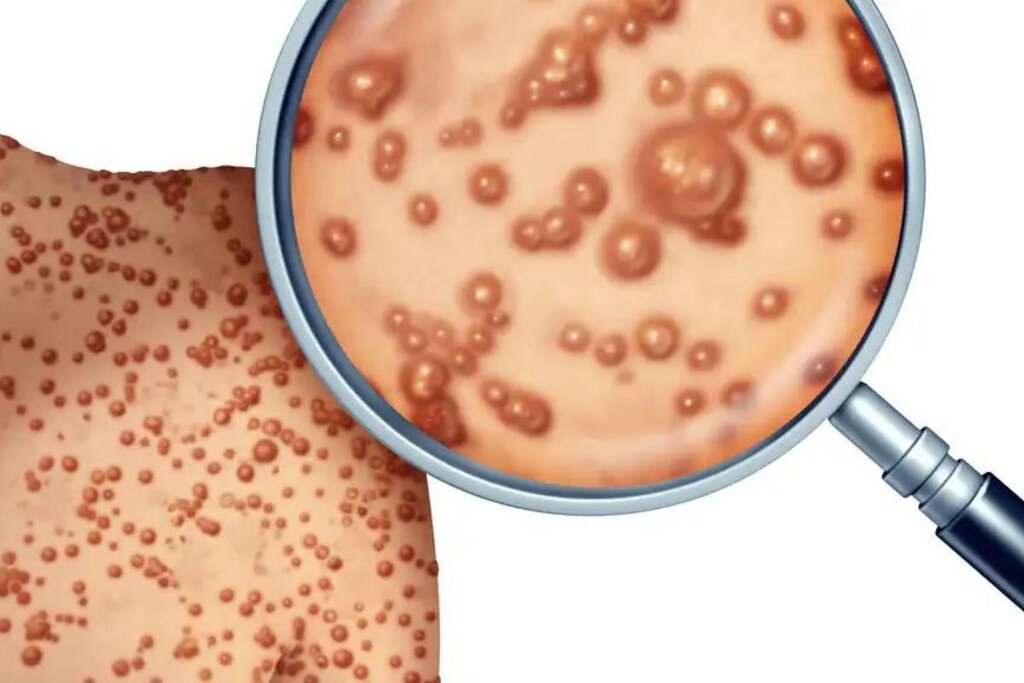 علائم آبله میمونی چه تفاوتی با آبله مرغان دارد؟ pox