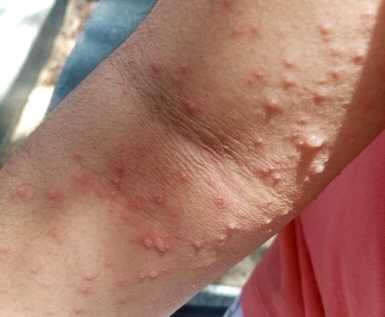 آبله میمونی