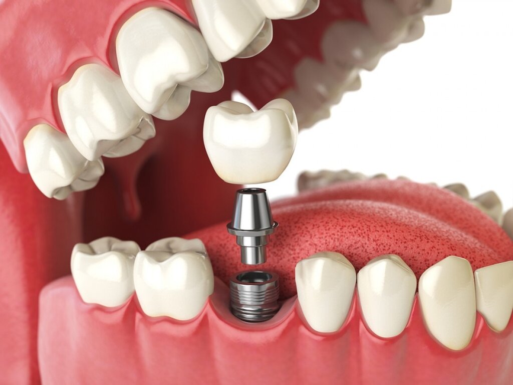 پیشرفت‌های جدید در ایمپلنت‌های دندانی| مینی ایمپلنت‌ها و قالب‌گیری دیجیتال