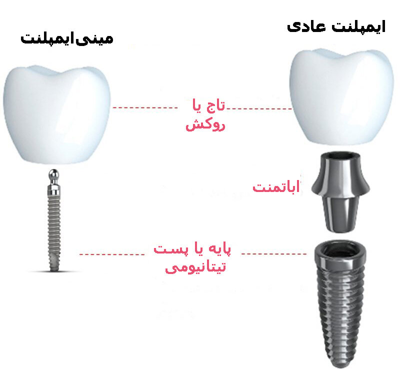 پیشرفت‌های جدید در ایمپلنت‌های دندانی| مینی ایمپلنت‌ها و قالب‌گیری دیجیتال