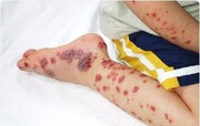 افزایش مبتلایان تب کریمه کنگو در ایران به ۳۴ نفر | چند نفر جان باختند؟