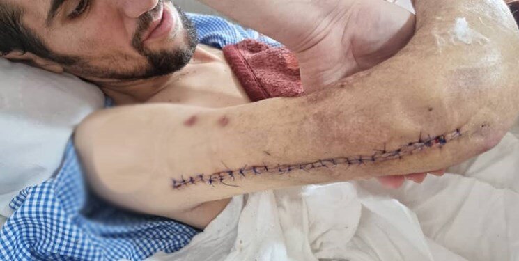 عکس | پیوند موفقیتآمیز دست جداشده یک کارگر در یزد