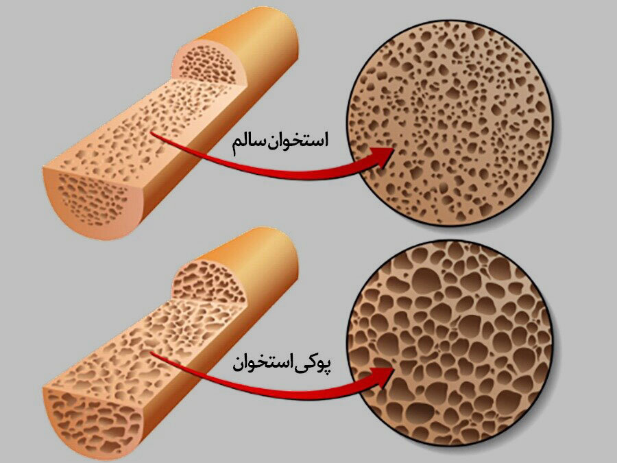 آمار وحشتناک مبتلایان پوکی استخوان در ایران | آماری عجیب از افرادی که با شکستگی لگن می‌میرند | این افراد حتما برای سنجش تراکم استخوان اقدام کنند